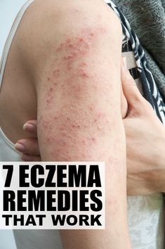 If you're on the hunt for eczema remedies that work quickly and effectively in treating dry, itchy, red, and raw skin, and that are suitable for kids and babies, this collection is a great place to start. From environmental factors to diet and product recommendations, these tips will help keep eczema at bay and prevent future flare ups. Home Remedies For Warts, Warts Remedy, Environmental Factors, Lose 40 Pounds, Yoga Sequences, Health Remedies, Home Remedies, Health Benefits