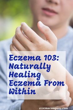 Trying to soothe your eczema with different creams and medications to no avail? It may be time to start looking at healing your eczema from within instead.  Keep reading for tips on how you can remove triggers from your life - including food triggers! Fatigue Remedies, Sinus Infection Remedies, I Healed, Holistic Health Nutrition, Ways To Heal, Natural Remedies For Allergies, Holistic Health Remedies, Holistic Remedies, Natural Health Remedies