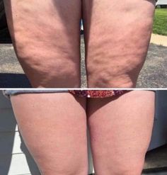 before and after photos of cell phone butts