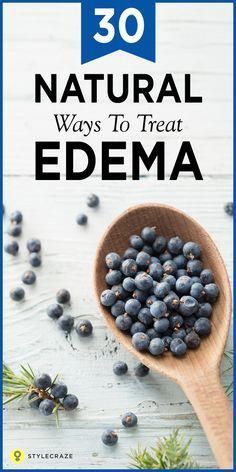 Edema is a health condition in which body fluids are retained in the tissues. Here are 25 remedies to cure edema, along with its causes, symptoms, and risks. Swollen Ankles, Swollen Legs, Water Retention, Daily Health Tips, Good Health Tips, Puffy Eyes, Health And Fitness Tips, Healthy Living Tips