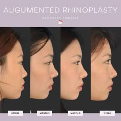 Flat Nose Asian, Nasal Surgery, Asian Nose, Medical Safety, Types Of Surgery