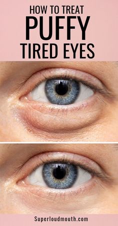 Eye Bag Remedies, Baggy Eyes, Swollen Eyes, Under Eye Bags, Beauty Remedies, Tired Eyes, Looks Black