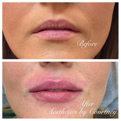 Lip Injections Juvederm, Juvederm Lips, Lip Model, Facial Procedure, Nurse Injector