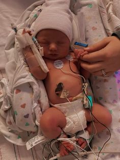 a newborn baby is being hooked up to an iv