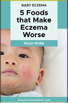 In the blog, the skincare experts at Eco Chic Movement are sharing tips about how to soothe your child's eczema. When it comes to natural treatments for baby eczema, that actually work, the key is to get to the root cause of the problem. And that starts by understanding what eczema really is. We share details so you can understand eczema and share our tips for soothing it for our baby. Natural Skin Care Products | Skin Concern | Eczema | Skin Care Tips Excema Diet For Kids, Excema Remedies For Kids, Baby Excema, Natural Skin Care Products, Health Talk, Exercise Tips, Parenting 101, Eco Chic