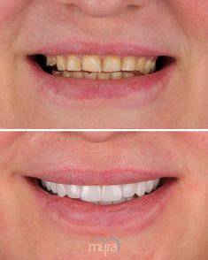 Nina Jeltekova’s dental journey highlights the importance of advanced techniques in achieving comprehensive smile rehabilitation. Her treatment plan included 14 Osstem implants, 4cc bone grafting, 1 sinus lift, 2 implant extractions, 2 temporary dentures, and 28 zirconium crowns.
Contact us today for a FREE Consultation to start your own transformation.
📞 +90 543 938 33 50
🌐 www.myradental.co.uk
#SmileTransformation #DentalImplants #ZirconiumCrowns #TeethTurkey #MyraDentalCentre