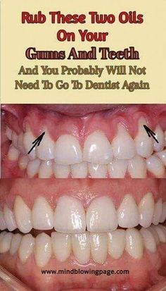 Explore ten simple and natural methods to care for receding gums effectively. Dental Hacks, Toddler Tooth Decay, Teeth Remedies, Tooth Decay Remedies, Teeth Whitening Homemade, Homemade Toothpaste, Healing Tips, Heal Cavities, Teeth Whitening Diy