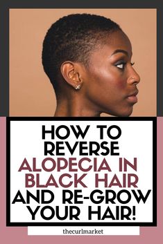 Alopecia Hair Growth, Alopecia Hairstyles, Hair Growing Tips, How To Grow Natural Hair, Bald Spot, Hair Remedies For Growth, Regrow Hair, Healthy Natural Hair