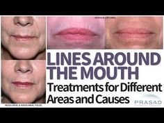 New York board-certified cosmetic surgeon Amiya Prasad MD discusses the best cosmetic treatment options for lines around the mouth. Lines Around Mouth, Smile Wrinkles, Home Remedies For Wrinkles, Cosmetic Fillers, Facial Aging, Facial Anatomy, Get Rid Of Wrinkles, Laser Resurfacing