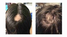 hair test results women Hair Test, New Hair Growth, Female Hair, Hair Control, Lost Hair, Hair Regrowth, Hair Health, Grow Hair, About Hair