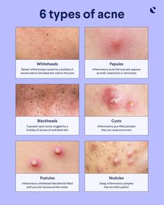 Nodule Acne, Back Acne Remedies, Different Types Of Acne, Forehead Acne, Severe Acne