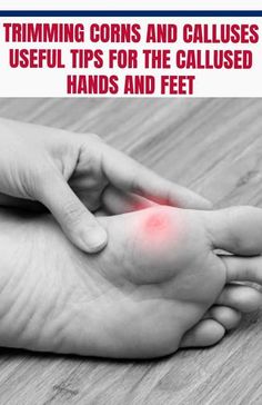 Calluses on toes can be tricky to reach due to their size and mobility. See how you can treat and care for the hardened calluses on your feet and toes. Calloused Feet Remedy, Best Callus Remover, Diy Natural Detergent, Callous Remover, Natural Face Cleanser, Bob Hairstyles For Fine Hair, Callus Removal, Toe Nails, How To Stay Healthy