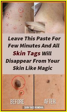 Remove Skin Tags, Tag Remover, Skin Tags, Beauty Remedies, Exam Preparation, Beauty Treatments, Skin Treatments