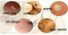 Skin tags, age spots, moles, and clogged pores are the most common skin issues that affect both sexes. They are usually a result of unhealthy lifestyle, genetics, hormonal imbalances, etc. There are... Jus Lemon, Diy Remedies, Natural Therapy, Skin Issues, Age Spots, Natural Home Remedies