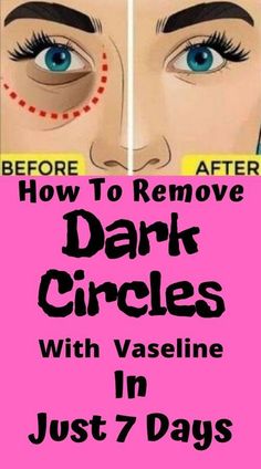 removedarkcircles,undereyedarkcircles,      vaselinehacks,emovedarkcircleswithvaseline,       getridofdarkcircles,vaseline,darkcircles Dark Circle Remedies, Dark Eye Circles, Dark Spots On Skin, Dark Under Eye