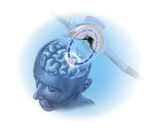 Luckily, there are varieties of different treatments available, which are crucial for patients who still suffer from depression. Treatment with Transcranial Magnetic Stimulators, also called TMS treatment, may be a great option for several people with depression. Transcranial Magnetic Stimulation, Nerve Cells, Nerve Cell, Mental Health Services, Magnetic Field, Improve Mood, Health Services, The Brain, Nerve