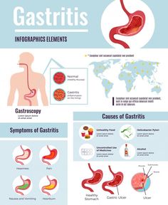 Stomach Ulcers Symptoms, Ulcer Symptoms, Healthy Stomach, Food Habits, Homeopathy Medicine, Stomach Ulcers, Infographic Poster