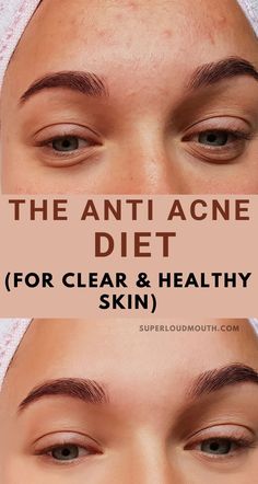 Acne Diet Plan, Anti Acne Diet, Clear And Glowing Skin, Acne Diet, Skin Diet, Clear Healthy Skin, Natural Acne Remedies