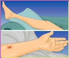 Bruises, also known as contusions, are caused by broken blood vessels under the surface of your skin. Typically, bruises are caused by falling, bumping into things, or getting hit with an object like a ball. While bruises fade over time,... Blemish Remover, Under The Surface, Blood Vessels, Your Skin, Skin