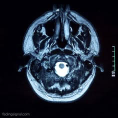 an x - ray image of the inside of a human skull