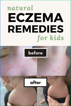 If you're wondering how to soothe eczema in children, here are two natural products that are safe and non toxic for your favorite little humans! Excema Remedies For Kids, Get Rid Of Excema, How To Get Rid Of Excema, Excema Remedies Diy, Baby Excema, Excema Relief, Itchy Skin Remedy, Severe Dry Skin, Essential Oils For Skin