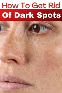 Spots On Forehead, Dark Spots Remedies, Banana Face Mask, Brown Spots On Skin, Get Rid Of Wrinkles, Brown Spots Removal, Brown Spots On Face, Skin Spots, Spots On Face