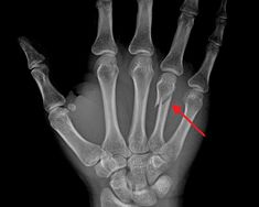 an x - ray shows the hand and wrist bones, with red arrow pointing towards it