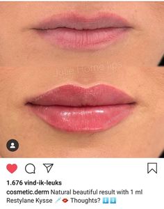 Restylane Kysse Lips Before And After, 1ml Lip Filler Small Lips, Julie Horne Lip Filler, Kysse Lips Filler Before And After, Lip Filler Shape Ideas Natural, 0 5 Ml Lip Filler, Natural Lip Fillers 1ml, Half Syringe Lip Filler Before And After