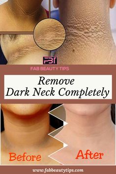 Dark Spots On Neck, Dark Skin Around Neck, Get Rid Of Dark Neck, Skin Lightening Diy, Glowing Face, Beauty Tips For Glowing Skin, Remove Dark Spots