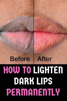 For Pink Lips, Natural Pink Lips, Home Remedies For Pimples, Remedies For Glowing Skin, Dark Lip, Lip Scrub Homemade