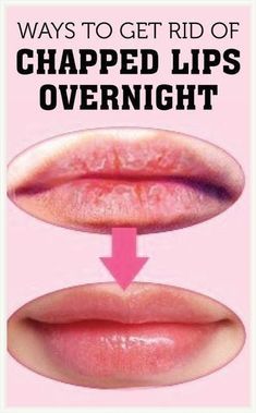 Remedies For Chapped Lips, Remove Upper Lip Hair Naturally, Remove Upper Lip Hair, Overnight Remedies, Upper Lip Hair, Ways To Heal, Get Rid Of Wrinkles, Wrinkle Remedies