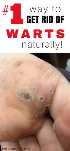 Warts can be painful and embarrassing to deal with. Ditch the over the counter chemicals and learn how to get rid of warts naturally! Natural Wart Remover, Planters Wart, Warts Remedy, Get Rid Of Warts, Cold Home Remedies, Lose 40 Pounds, Natural Home Remedies, Natural Medicine, Health Remedies