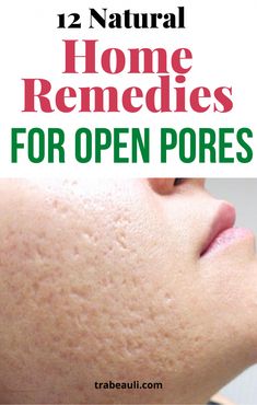 Looking for best natural treatment to get rid of open pores? if yes, so check out home remedies for open pores close at home Remedies For Pores On Face, Reduce Pores On Face Diy, Reduce Open Pores On Face, Clean Pores On Face Diy, Pore Tightening Products, How To Reduce Open Pores On Face, Open Pores Remedy Natural Treatments, Home Remedy For Open Pores, Open Pores On Face