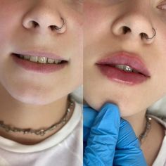 Russian Lip Filler Aesthetic, Small Lips Lip Filler, Bigger Bottom Lip, Heavy Upper Lip, Korean Lip Filler, Lip Filler Styles, Keyhole Lips, Lip Injections Before And After, Small Lips Makeup