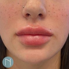 Height Exercise, Lip Surgery, Increase Height Exercise, Lips Inspiration, Understood The Assignment, Anime Lips, Lip Filler, Full Lips, Lip Fillers