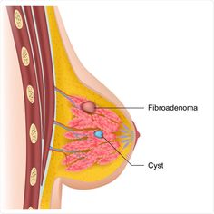 Breast cysts and fibroadenoma medical illustration. Credit: medicalstocks / Shutterstock Vegan Probiotics, Heart Diet, Warning Signs, Lose Belly, New Orleans