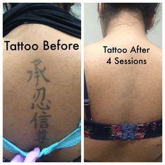 before and after photos of tattoo removals on the back of a woman's shoulder