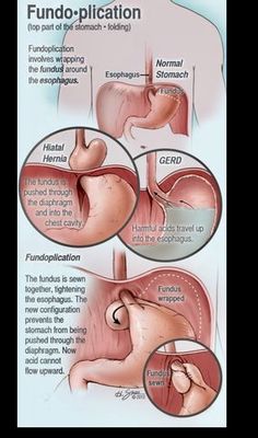 Surgery Nurse, Stop Acid Reflux, Medicine Notes, Nursing Memes, Medical Knowledge, Medical Education