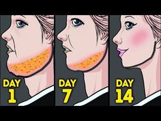 the stages of acne on woman's face, with text that reads day 7