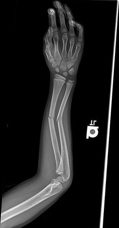 an x - ray image of a hand and wrist with the bones labeled in white