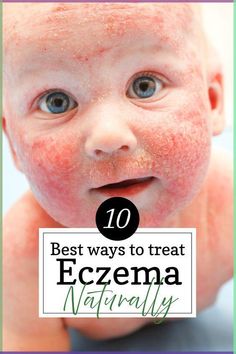 Doctors often prescribe topical steroids to treat eczema, however long term use can carry some nasty side effects. Fortunately, there are many ways in which you can treat eczema naturally. As a mother who had 2 babies with severe eczema and allergies - I have personally put together this guide for the best ways I've found to treat eczema naturally. Fat Removal, Do Exercise, Easy Workouts, Orange County, Baby Face, Coding