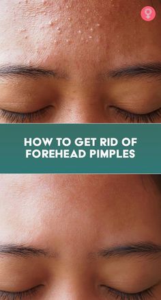 Forehead acne is a condition that affects many men and women worldwide. Learn about its causes, treatment options, and how to prevent it from coming back. Forehead Pimples, Small Bumps On Face, Forehead Bumps, Pimples On Forehead, Blind Pimple, Forehead Acne, Pimples Under The Skin, Bad Acne, Pimples Overnight