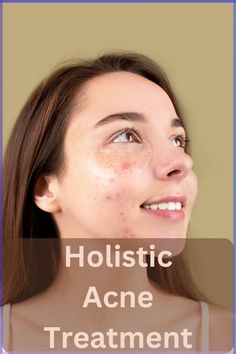 Holistic Acne Treatment: Autumn is the best time of the year to take care of your acne. Living with acne with its fluctuating nature is not easy. But you don’t need to suffer. I have a Naturopathic Holistic Acne Treatment course for your acne that target the root causes of acne individualized to your unique needs and circumstances. Causes Of Acne, Back Acne, Morning Skincare