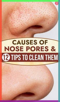 Are the pores on your nose getting bigger? Such big pores are a result of accumulated dirt that can harm the skin. Is there a way to unclog and shrink them Clean Nose Pores, Eye Health Remedies, Big Pores, Nose Pores, Natural Face Skin Care, Best Moisturizer, Clean Pores, Unclog Pores