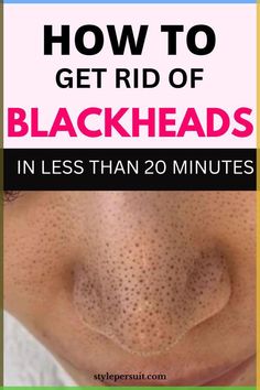 You can easily get rid of these blackheads by using natural or home remedies for blackhead treatment. Click to read How to get rid of blackheads diy| The best blackheads removal on nose| get rid of blackhads on face| get rid of blackheads on nose| how to get rid of blackheads naturally ... Aloe Vera For Scars, Blackhead Remedies, Blackheads On Nose, Rid Of Blackheads, Blackhead Mask, Anti Wrinkle Treatments, Prevent Pimples, Blackheads Removal, Types Of Acne