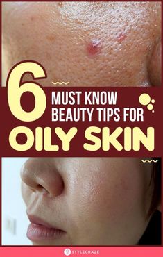 Oily skin can take you through tough times as the sebaceous glands are over-active, producing excess sebum, contributing to a shiny, greasy-looking face and skin concerns such as acne, blackheads and whiteheads, enlarged or clogged pores etc. The solution for this is to keep the oil production in control by following some simple beauty and skin care tips for oily skin. #Skincare #SkincareTips #OilySkin #Beauty #BeautyTips Beauty Tips For Oily Skin, Oily Skin Skincare, Blackheads And Whiteheads, Lotion For Oily Skin, Tips For Oily Skin, Beauty And Skin Care, Oily Face, Moisturizer For Oily Skin, Oily Skin Care