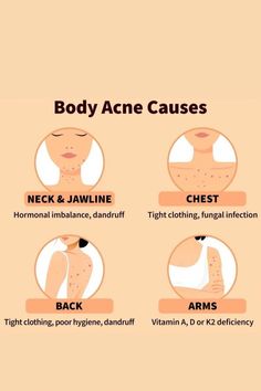 Bad Acne, Skin Advice, Clear Healthy Skin, Acne Skincare, Natural Acne Remedies, Types Of Acne, Body Acne, Acne Causes