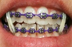 Smile With Braces, Purple Braces, Dental Braces Colors, Invisible Teeth Braces, Braces Rubber Bands, Cute Braces Colors