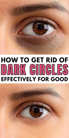 Eye Circle Remedies, Dark Circle Remedies, Dark Circles Around Eyes, Dark Eye Circles, Eye Cream For Dark Circles, Dark Under Eye, Reduce Dark Circles, Under Eyes