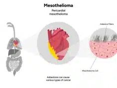 the diagram shows different types of mesothenalia, including an anteropism